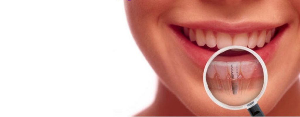 Reasons Why You May Choose To Have Dental Implants