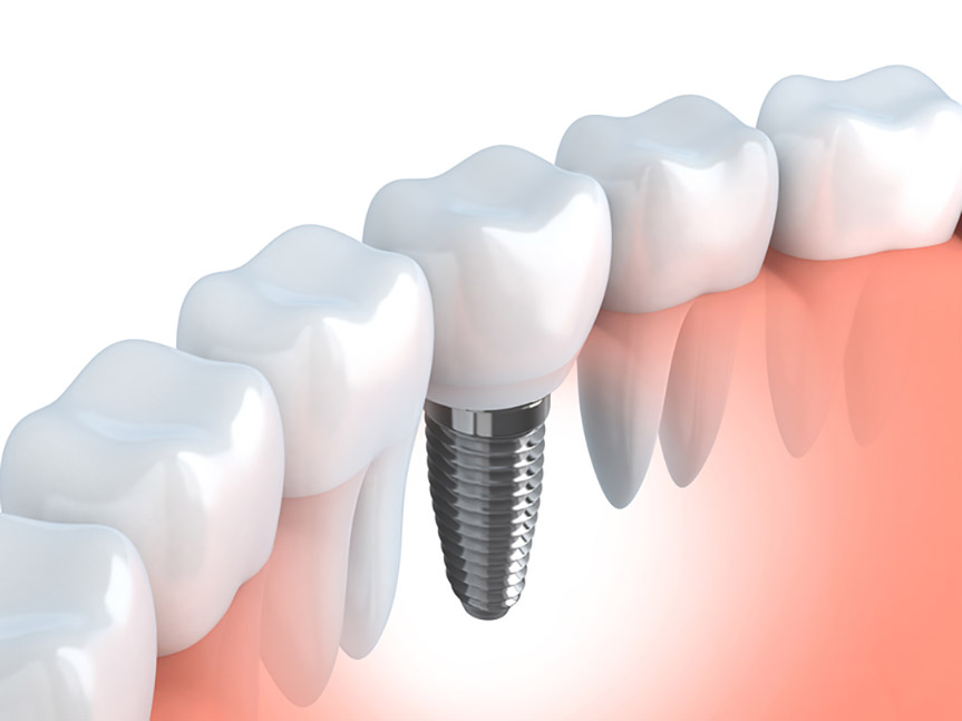 Do I Need More Than One Dental Implant?