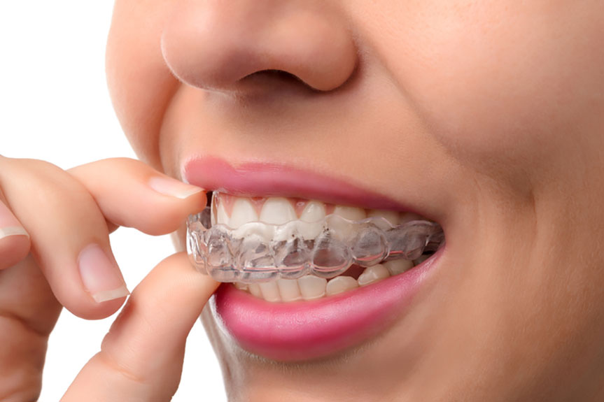 Your Next Best Options When You Don’t Want to Wear Adult Braces